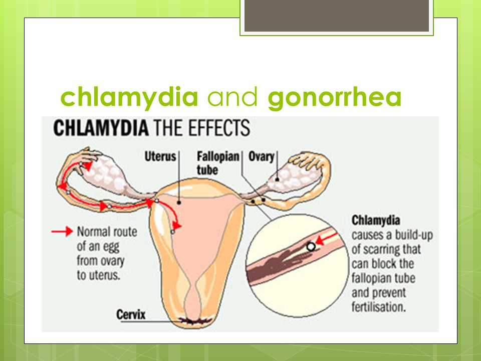 chlamydia and gonorrhea