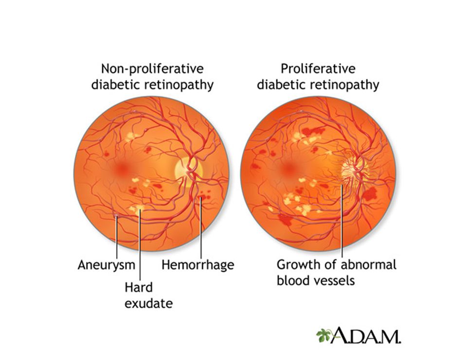 Диабетическая ретинопатия это. Препролиферативная диабетическая ретинопатия. Осложнения диабетической ретинопатии. 1 Стадия диабетической ретинопатии. Острота зрения при диабетической ретинопатии.