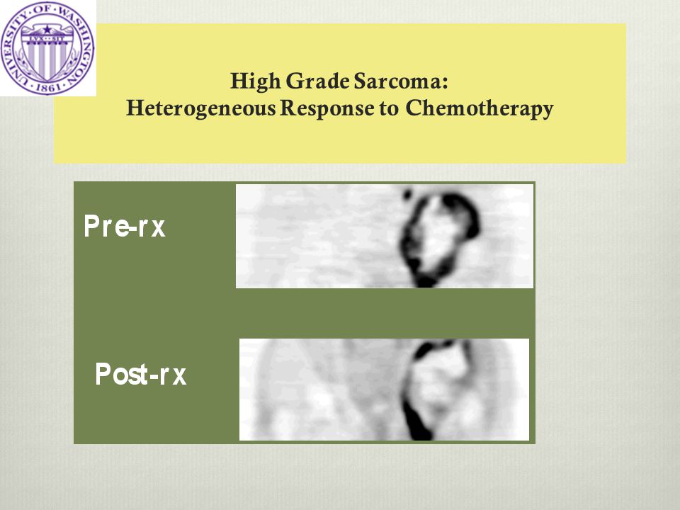 High Grade Sarcoma: Heterogeneous Response to Chemotherapy