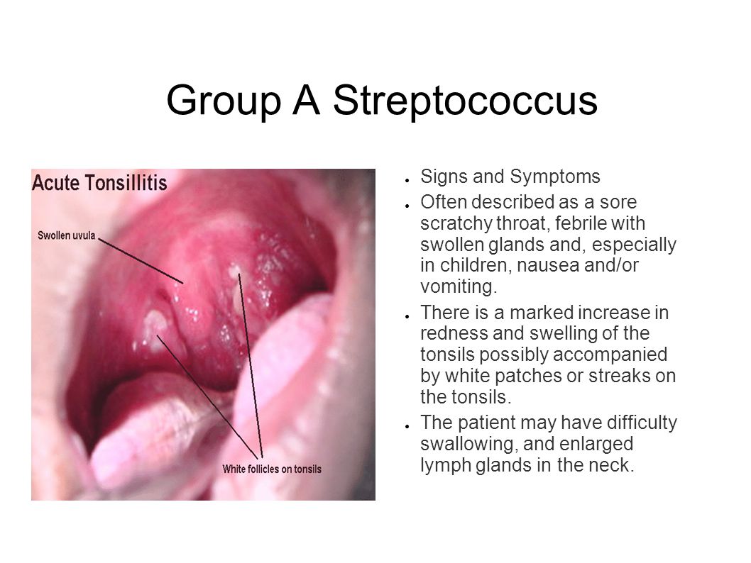 Group b strep infection in nonpregnant adult, celeb cum pics