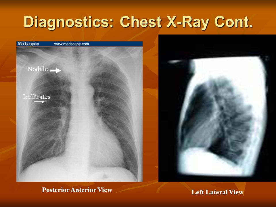 Diagnostics: Chest X-Ray Cont. Posterior Anterior View Left Lateral View Nodule Infiltrates
