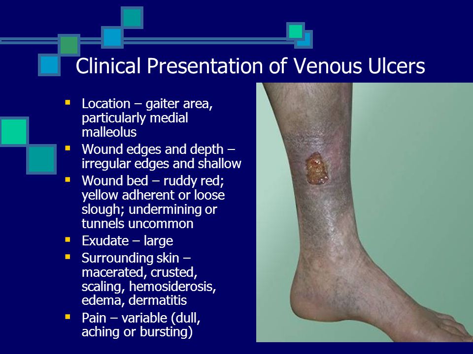 Arterial and Venous Ulcers Presented by Amelia E. Quiz Emory University. -  ppt download