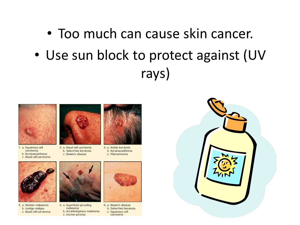 Too much can cause skin cancer. Use sun block to protect against (UV rays)