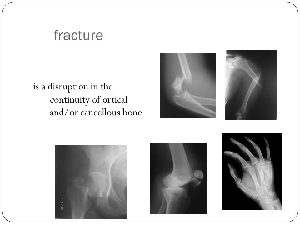 Definition Classification Causes Fractures Orthopedics History Ortho Straight Paedia Child Straightening Of Musculoskeletal Deformities In Children Ppt Download