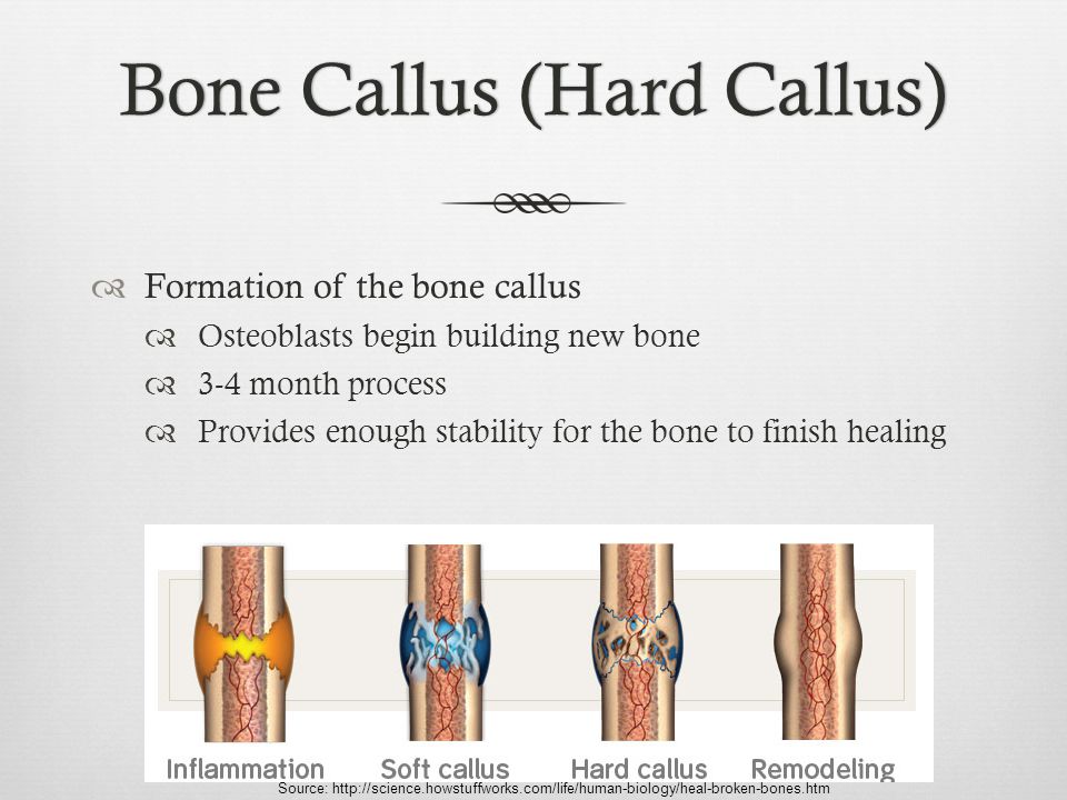 Bone Callus (Hard Callus)Bone Callus (Hard Callus)  Formation of the bone callus  Osteoblasts begin building new bone  3-4 month process  Provides enough stability for the bone to finish healing Source: