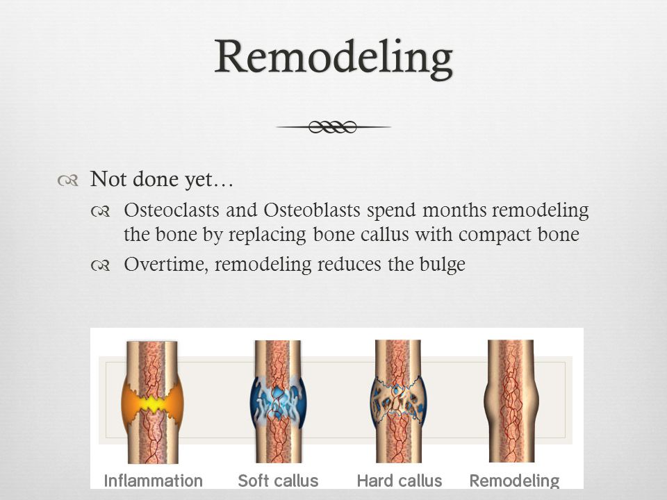 Remodeling  Not done yet…  Osteoclasts and Osteoblasts spend months remodeling the bone by replacing bone callus with compact bone  Overtime, remodeling reduces the bulge