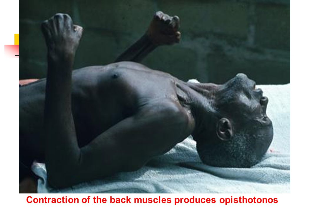 Contraction of the back muscles produces opisthotonos