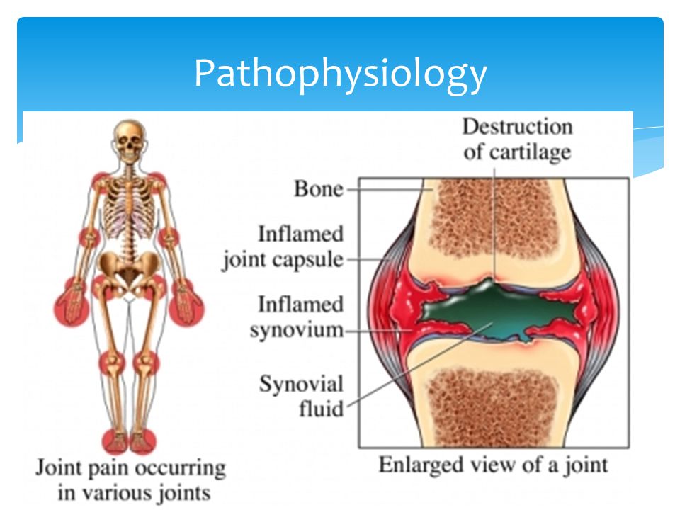Ревматическое поражение суставов. Ревматический полиартрит поражение суставов. Клинические проявления ревматоидного полиартрита. Поражение суставов при ревматическом полиартрите. Ревматический полиартрит характеризуется.