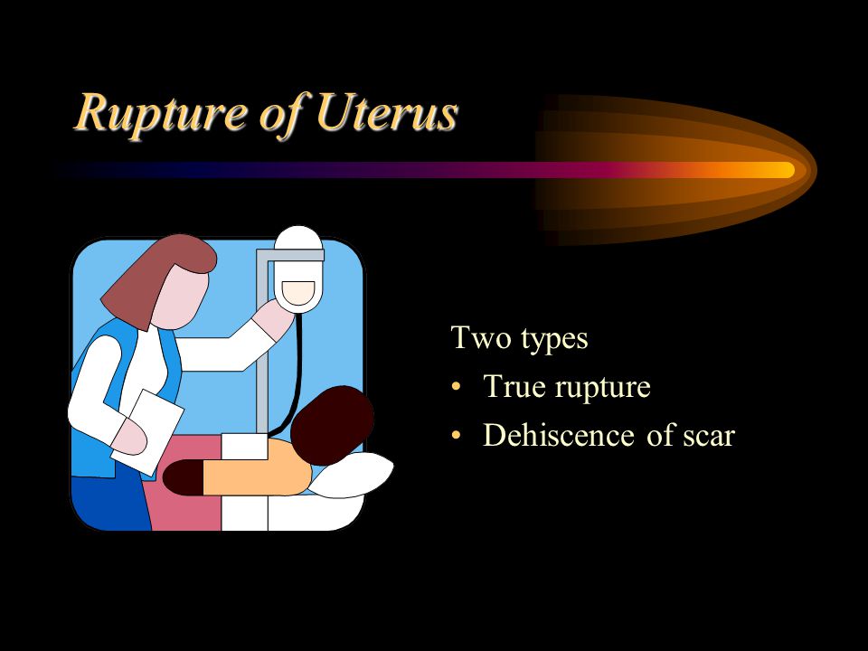 Rupture of Uterus Two types True rupture Dehiscence of scar