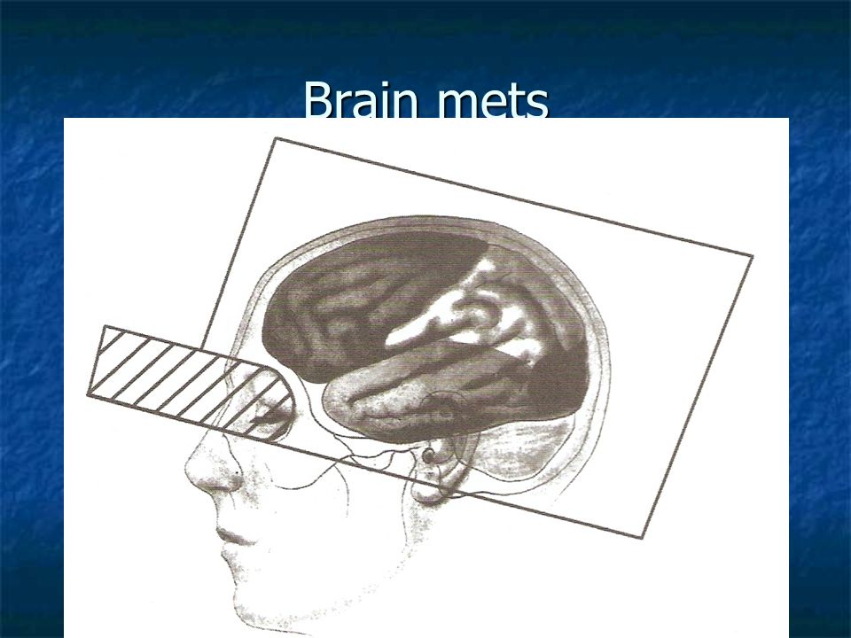 Brain mets