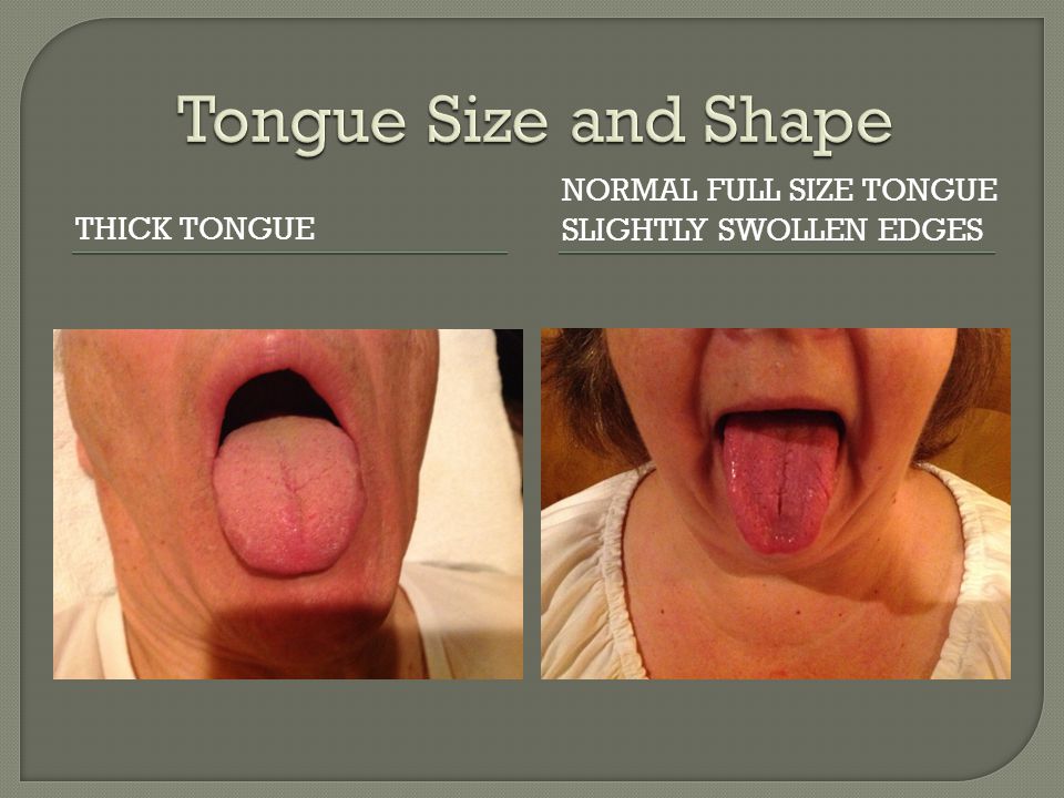 THICK TONGUE NORMAL FULL SIZE TONGUE SLIGHTLY SWOLLEN EDGES