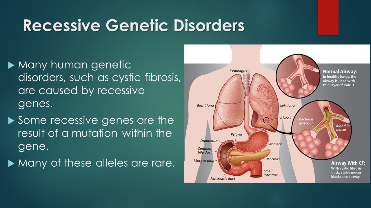 Recessive Genetic Disorders  Many human genetic disorders, such as cystic fibrosis, are caused by recessive genes.