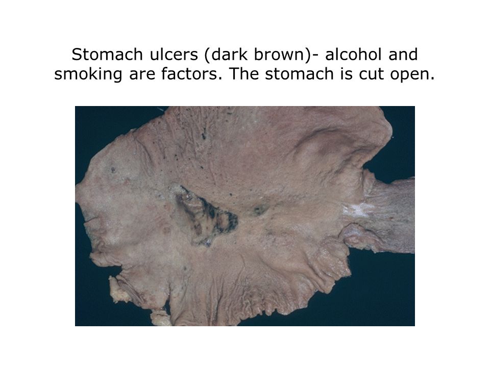 Stomach ulcers (dark brown)- alcohol and smoking are factors. The stomach is cut open.
