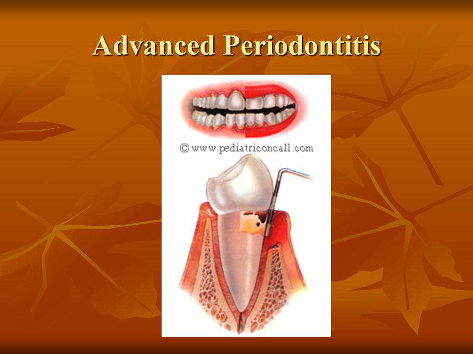 Advanced Periodontitis