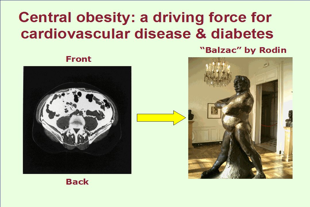 28 Central obesity: a driving force for cardiovascular disease & diabetes Balzac by Rodin Front Back