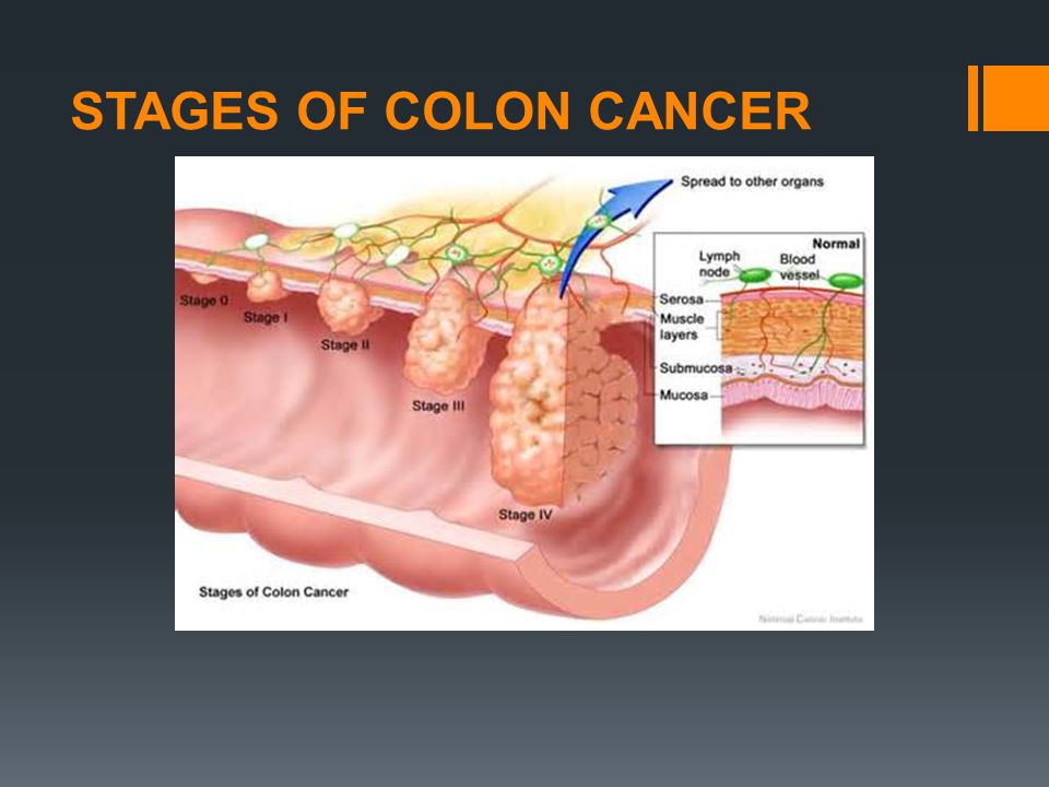 STAGES OF COLON CANCER