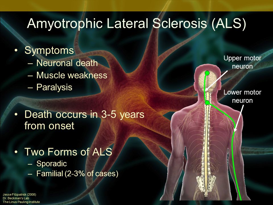 Amyotrophic Lateral Sclerosis (ALS) Symptoms –Neuronal death –Muscle weakness –Paralysis Death occurs in 3-5 years from onset Two Forms of ALS –Sporadic –Familial (2-3% of cases) Jesse Fitzpatrick (2008) Dr.