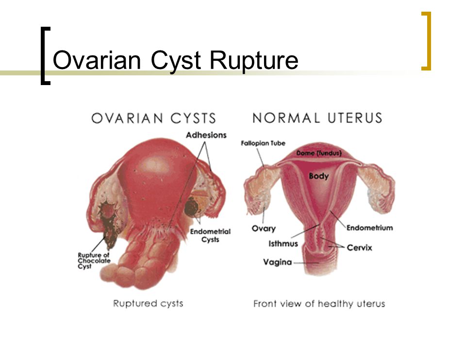 Ovarian Cancer And Cysts