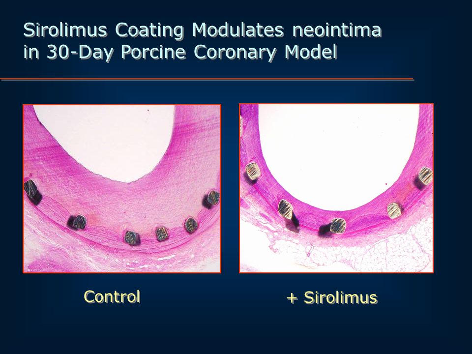 Sirolimus Coating Modulates neointima in 30-Day Porcine Coronary Model Sirolimus Coating Modulates neointima in 30-Day Porcine Coronary Model Control + Sirolimus
