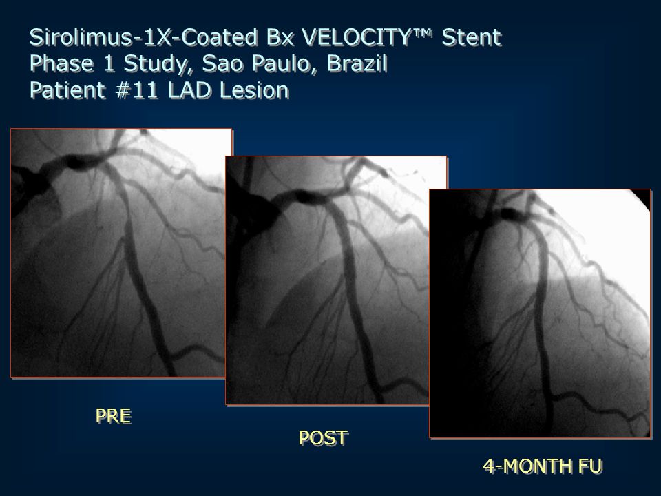 Sirolimus-1X-Coated Bx VELOCITY™ Stent Phase 1 Study, Sao Paulo, Brazil Patient #11 LAD Lesion Sirolimus-1X-Coated Bx VELOCITY™ Stent Phase 1 Study, Sao Paulo, Brazil Patient #11 LAD Lesion PRE POST 4-MONTH FU