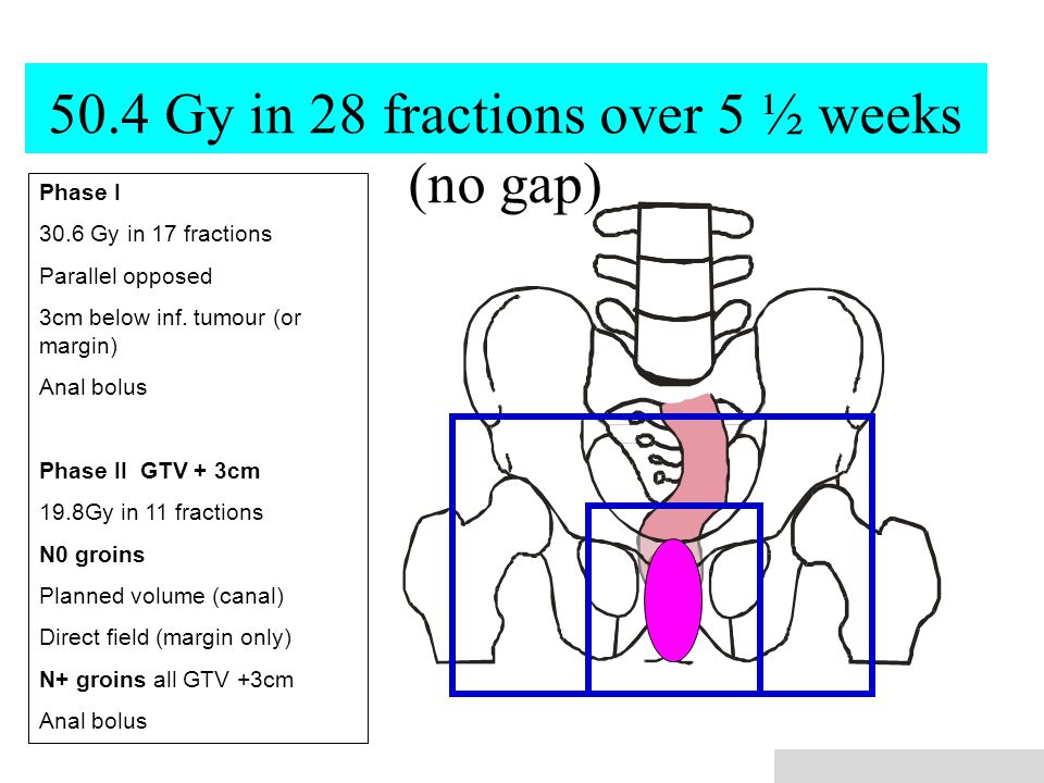 50.4 Gy in 28 fractions over 5 ½ weeks (no gap) Phase I 30.6 Gy in 17 fractions Parallel opposed 3cm below inf.