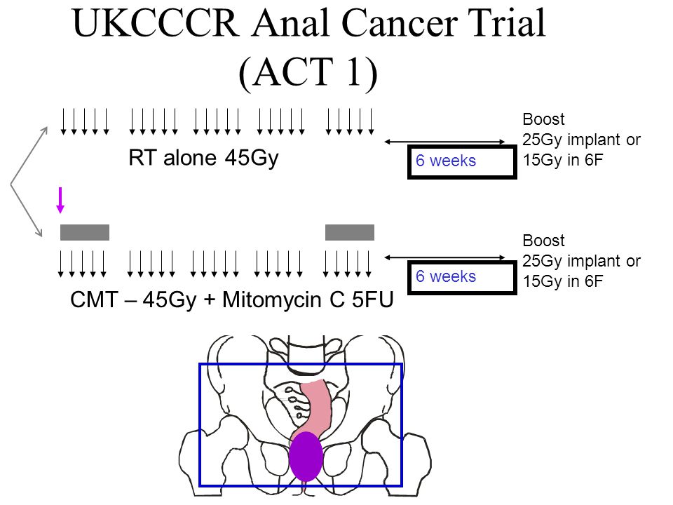 UKCCCR Anal Cancer Trial (ACT 1) CMT – 45Gy + Mitomycin C 5FU RT alone 45Gy Boost 25Gy implant or 15Gy in 6F Boost 25Gy implant or 15Gy in 6F 6 weeks