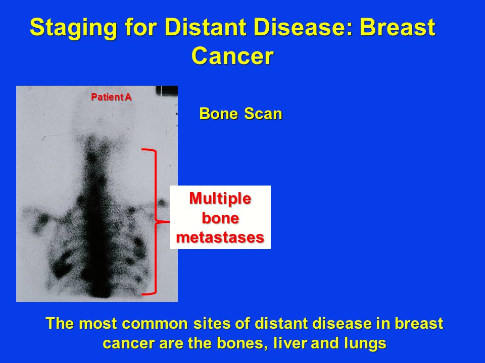 Bone Scan Staging for Distant Disease: Breast Cancer Multiple bone metastases Patient A The most common sites of distant disease in breast cancer are the bones, liver and lungs