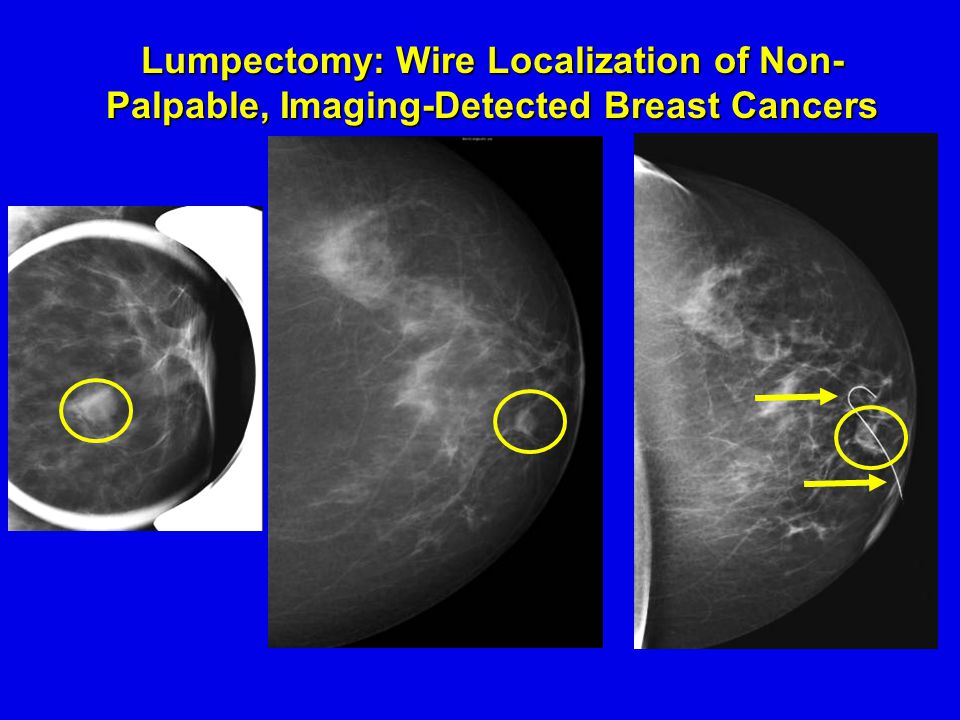 Lumpectomy: Wire Localization of Non- Palpable, Imaging-Detected Breast Cancers