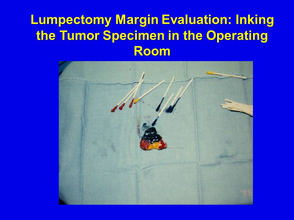 Lumpectomy Margin Evaluation: Inking the Tumor Specimen in the Operating Room