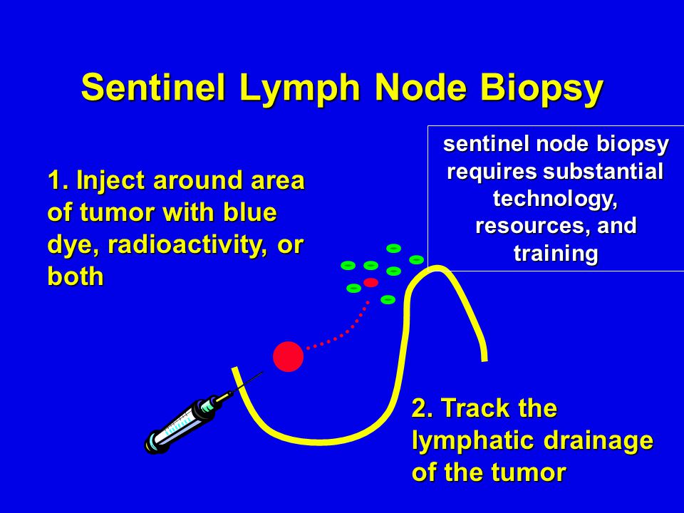 Sentinel Lymph Node Biopsy 1. Inject around area of tumor with blue dye, radioactivity, or both 2.