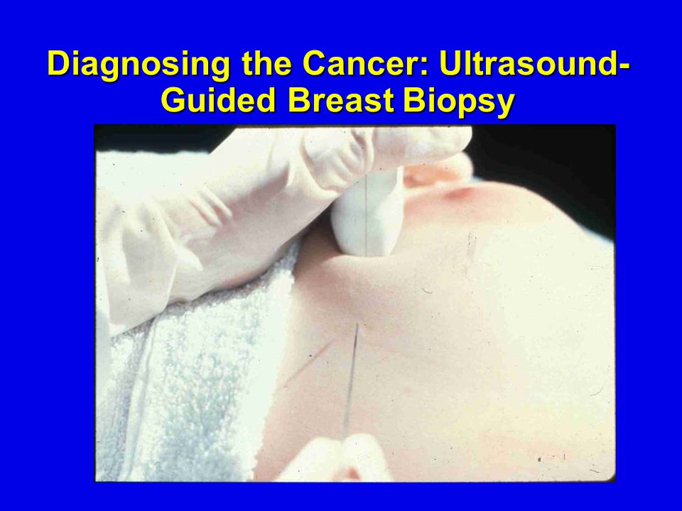 Diagnosing the Cancer: Ultrasound- Guided Breast Biopsy