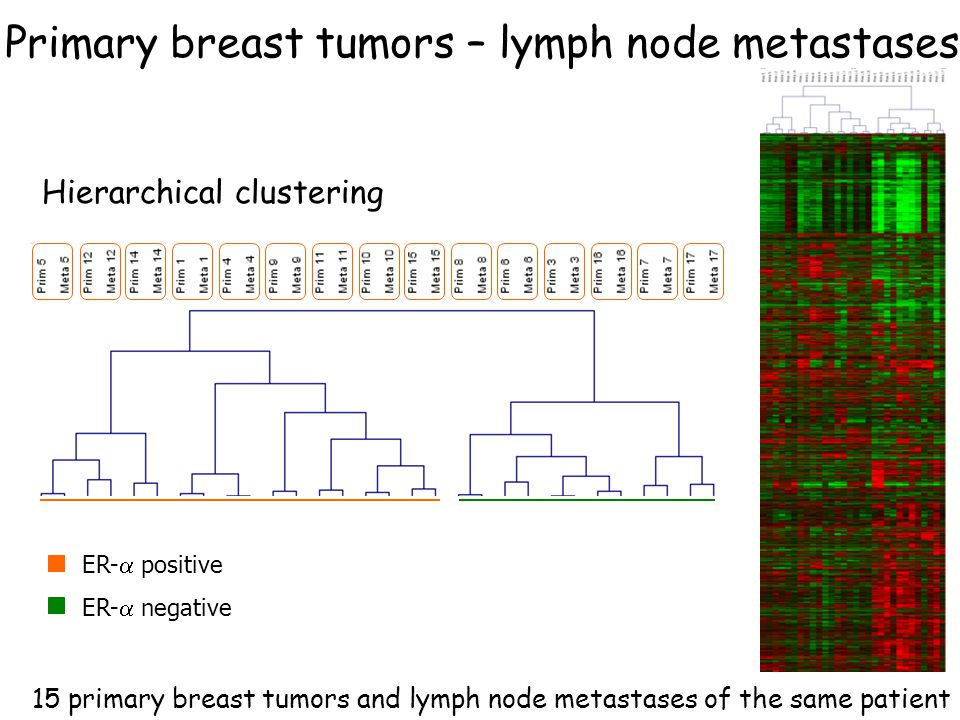 ER-  positive ER-  negative 15 primary breast tumors and lymph node metastases of the same patient Hierarchical clustering Primary breast tumors – lymph node metastases