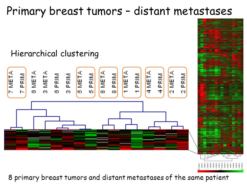Hierarchical clustering Primary breast tumors – distant metastases 8 primary breast tumors and distant metastases of the same patient