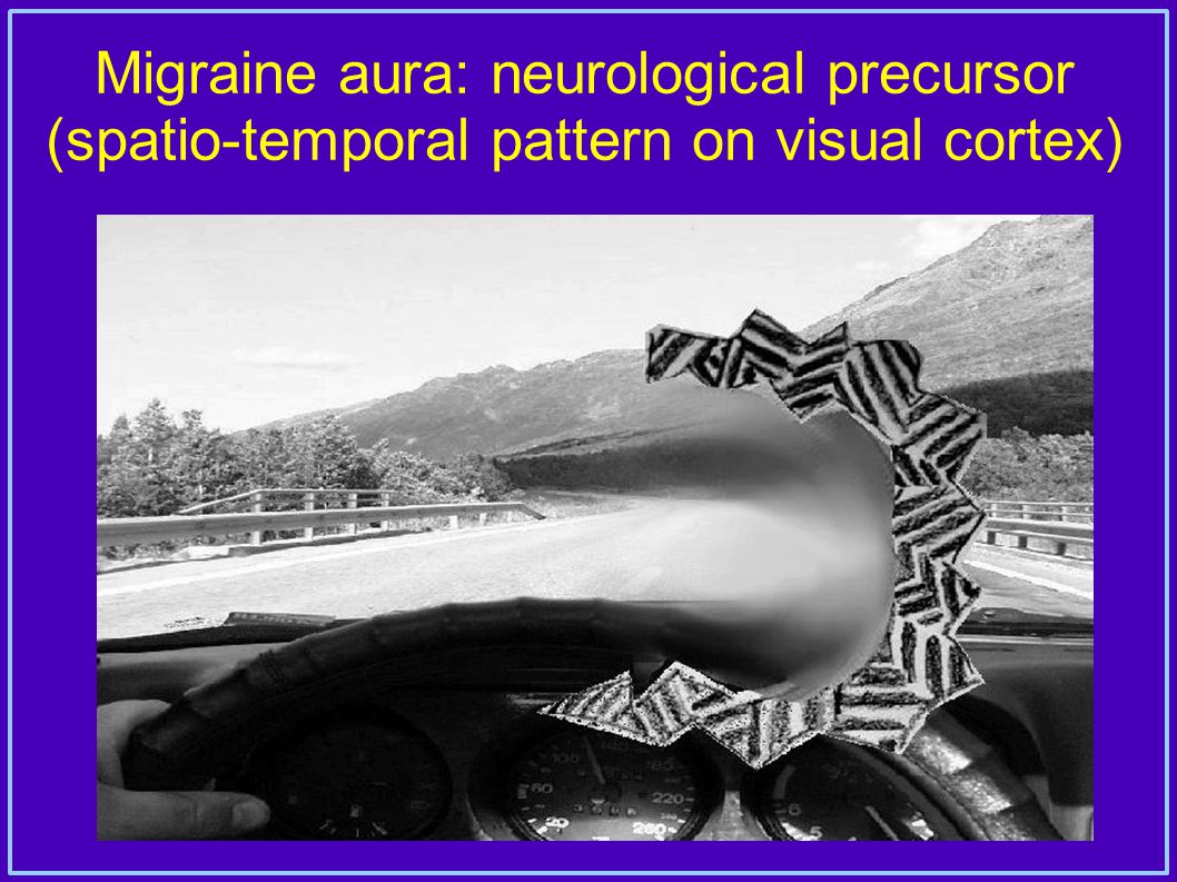 Migraine aura: neurological precursor (spatio-temporal pattern on visual cortex)