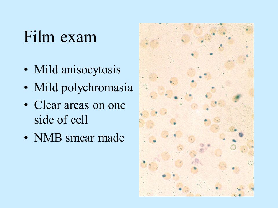 What Does Slight Polychromasia Mean Which of the following is incorrect. A Resting stem cells are resistant