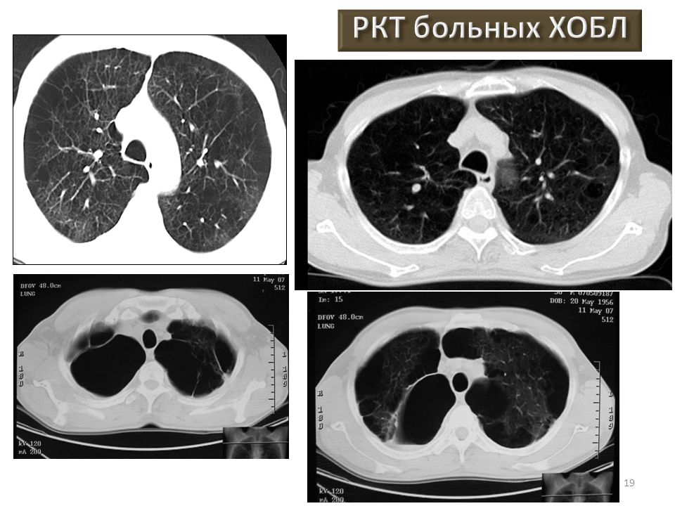 Хобл картина кт