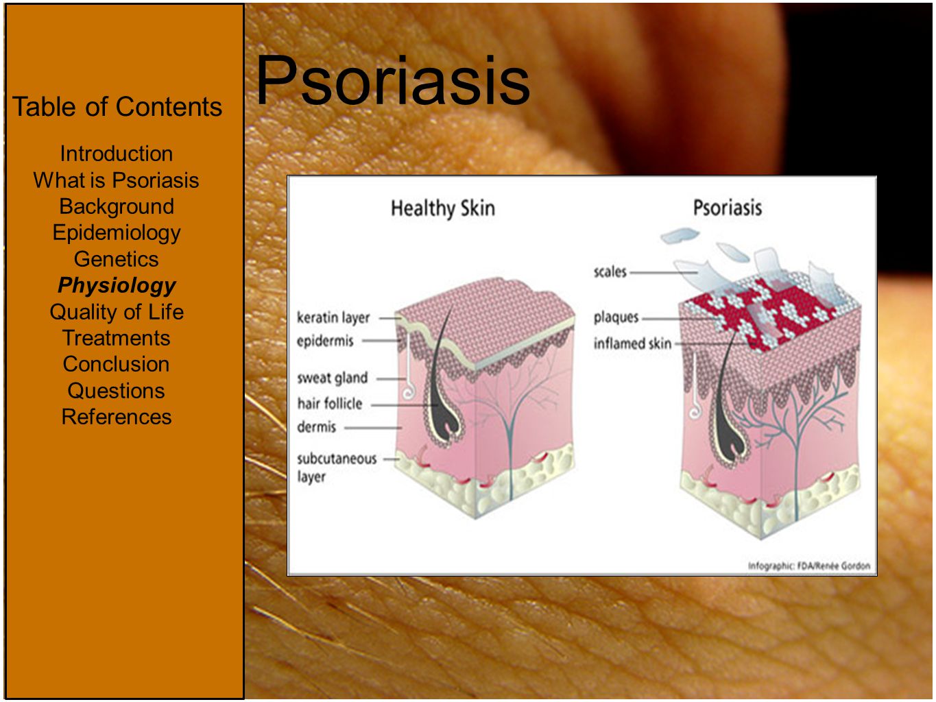 psoriasis introduction