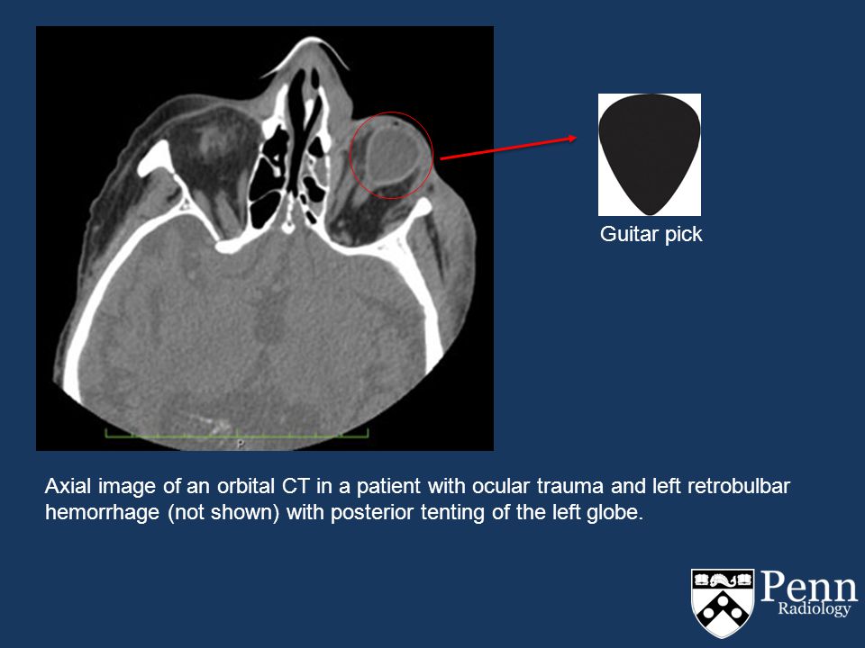 The “Guitar Pick” Sign: An expanding repertoire of orbital pathology  Vincent Dam MD, Joel Stein MD, PhD, Suyash Mohan MD Department of Radiology  Perelman. - ppt download