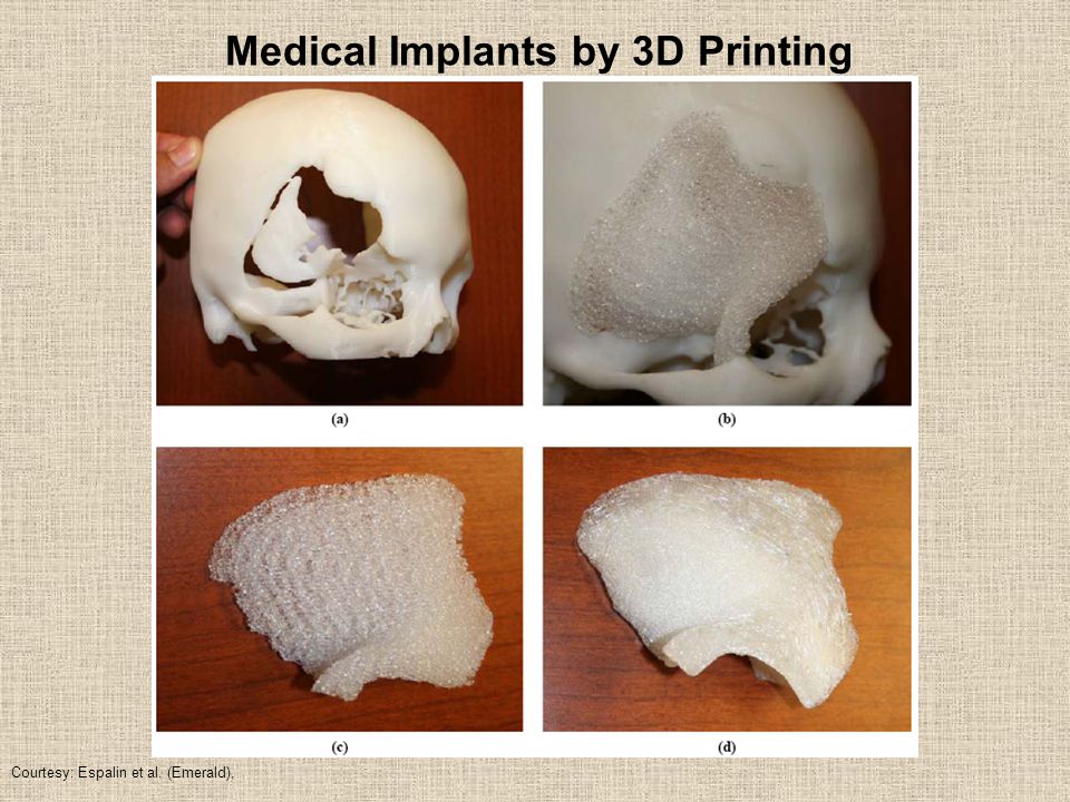 Medical Implants by 3D Printing Courtesy: Espalin et al. (Emerald),