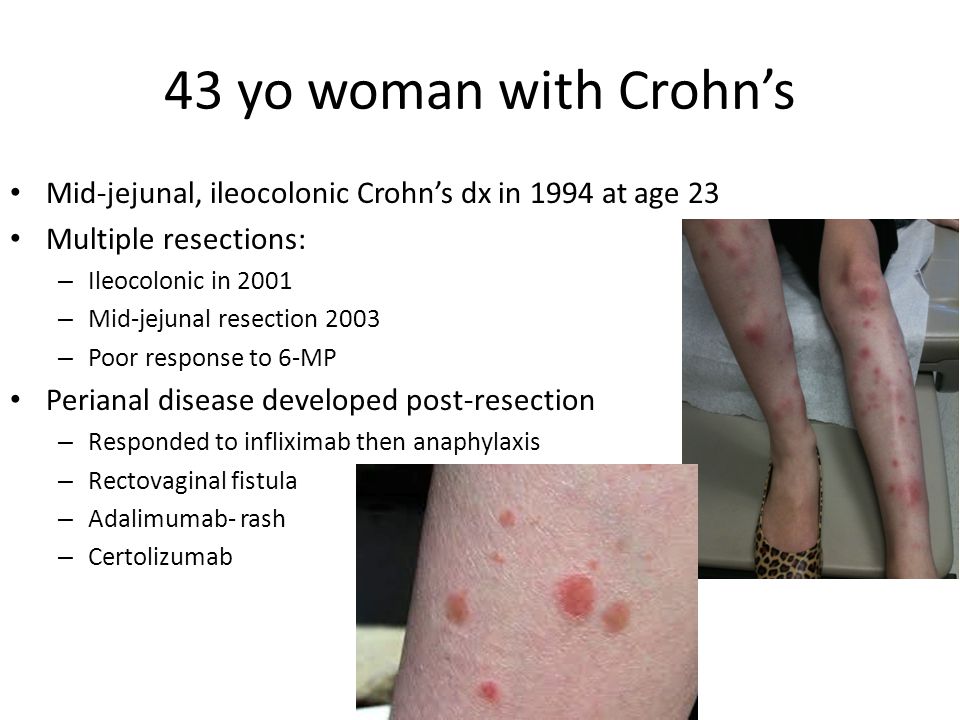 43 yo woman with Crohn’s Mid-jejunal, ileocolonic Crohn’s dx in 1994 at age 23 Multiple resections: – Ileocolonic in 2001 – Mid-jejunal resection 2003 – Poor response to 6-MP Perianal disease developed post-resection – Responded to infliximab then anaphylaxis – Rectovaginal fistula – Adalimumab- rash – Certolizumab