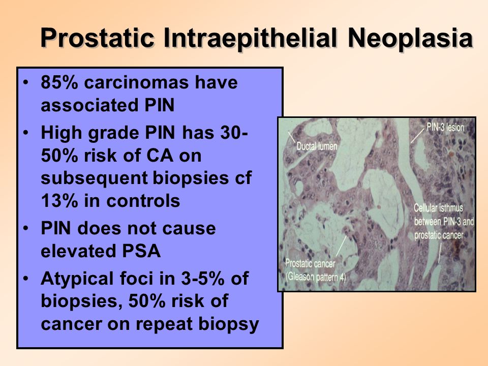 Prostatic Intraepithelial Neoplasia 85% carcinomas have associated PIN High grade PIN has % risk of CA on subsequent biopsies cf 13% in controls PIN does not cause elevated PSA Atypical foci in 3-5% of biopsies, 50% risk of cancer on repeat biopsy