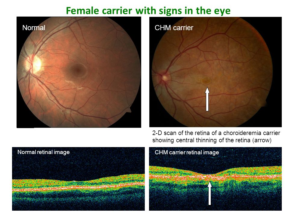 Fundus Of A 9 Year Old CHM Male Left The Pigment Layer Has Fundus Of A 9 Year Old CHM Male Left The Pigment Layer Has