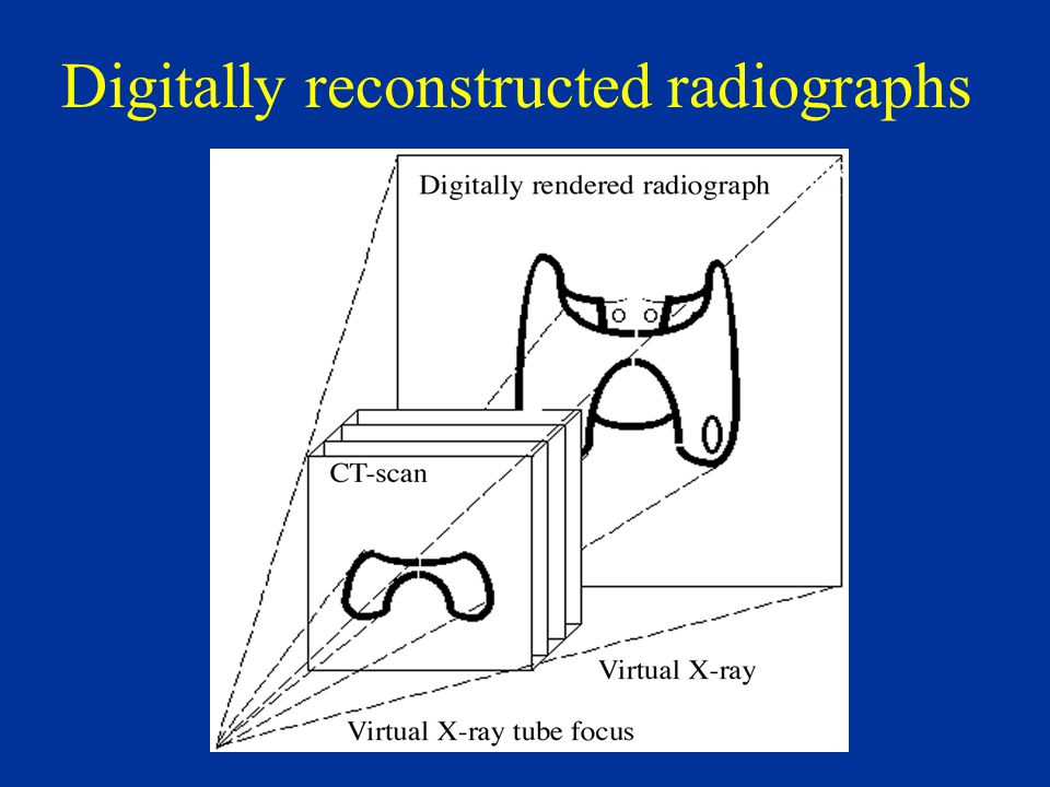 Digitally reconstructed radiographs