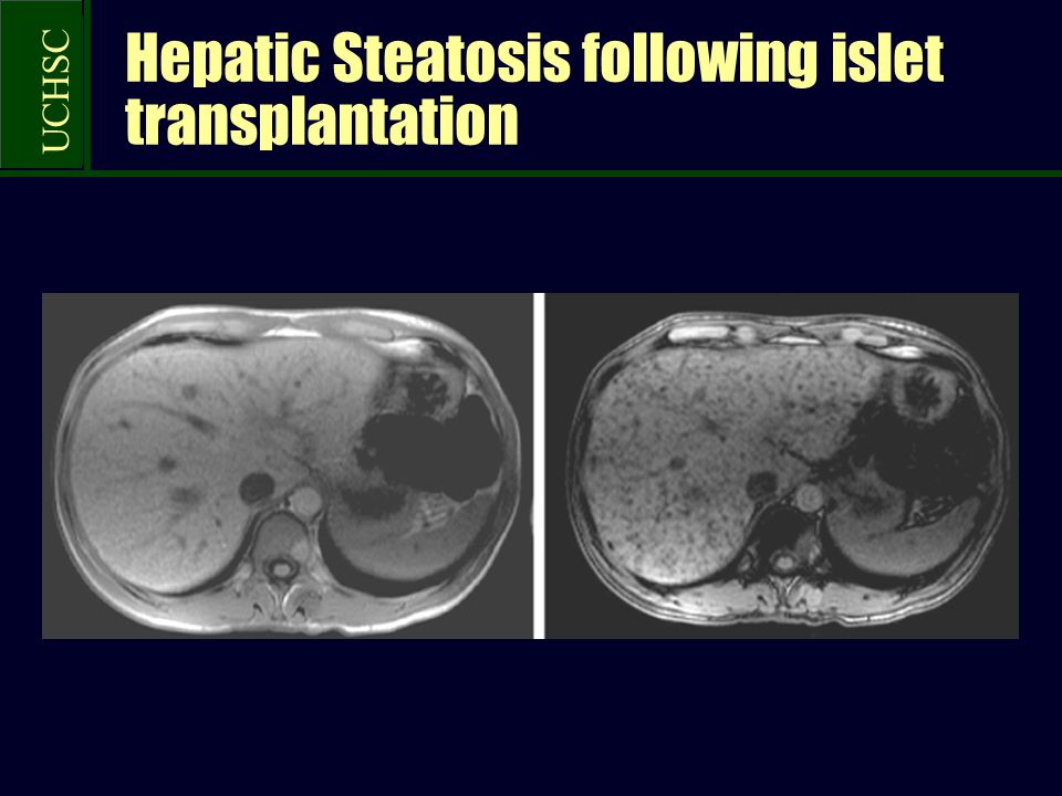 UCHSC Hepatic Steatosis following islet transplantation
