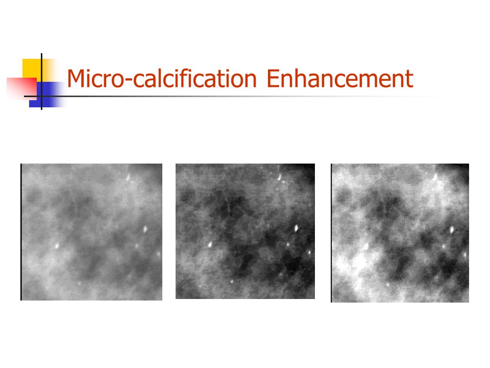 Micro-calcification Enhancement