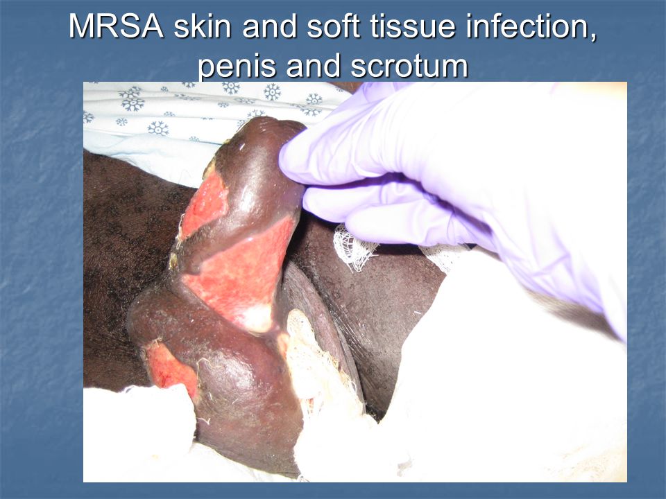 mrsa on penis Avatar chat sex