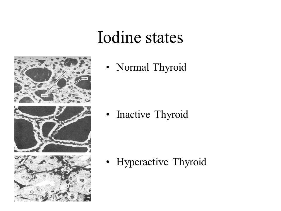 Iodine states Normal Thyroid Inactive Thyroid Hyperactive Thyroid