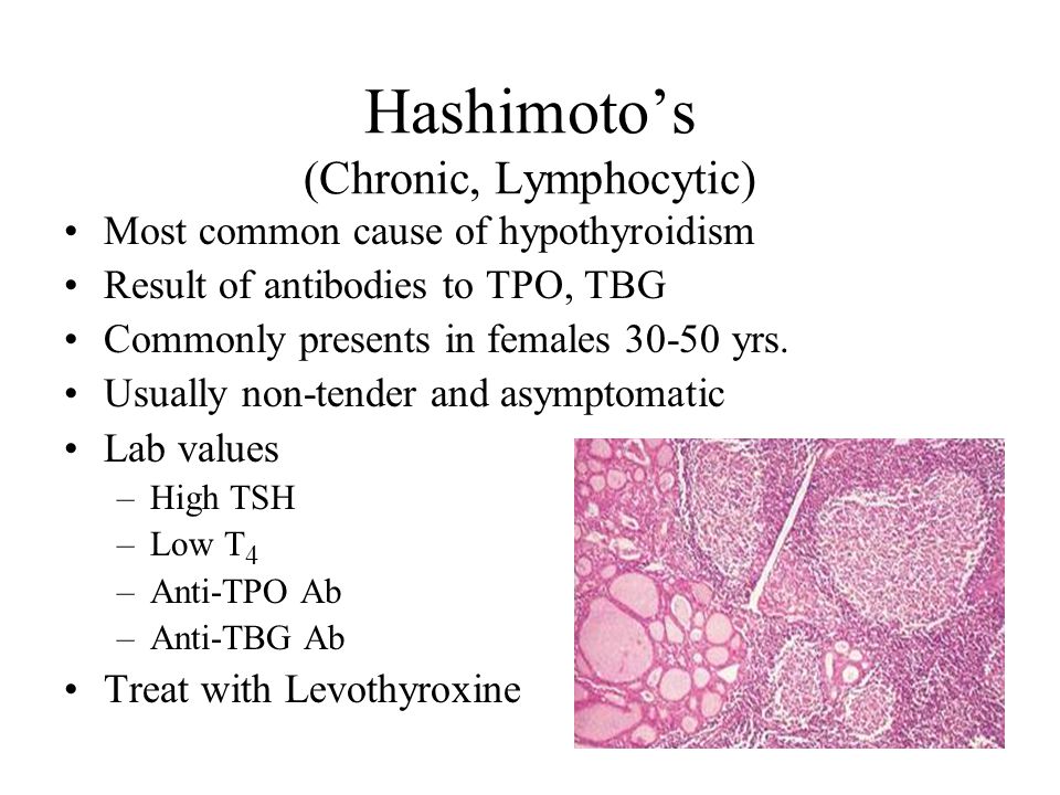 Hashimoto’s (Chronic, Lymphocytic) Most common cause of hypothyroidism Result of antibodies to TPO, TBG Commonly presents in females yrs.