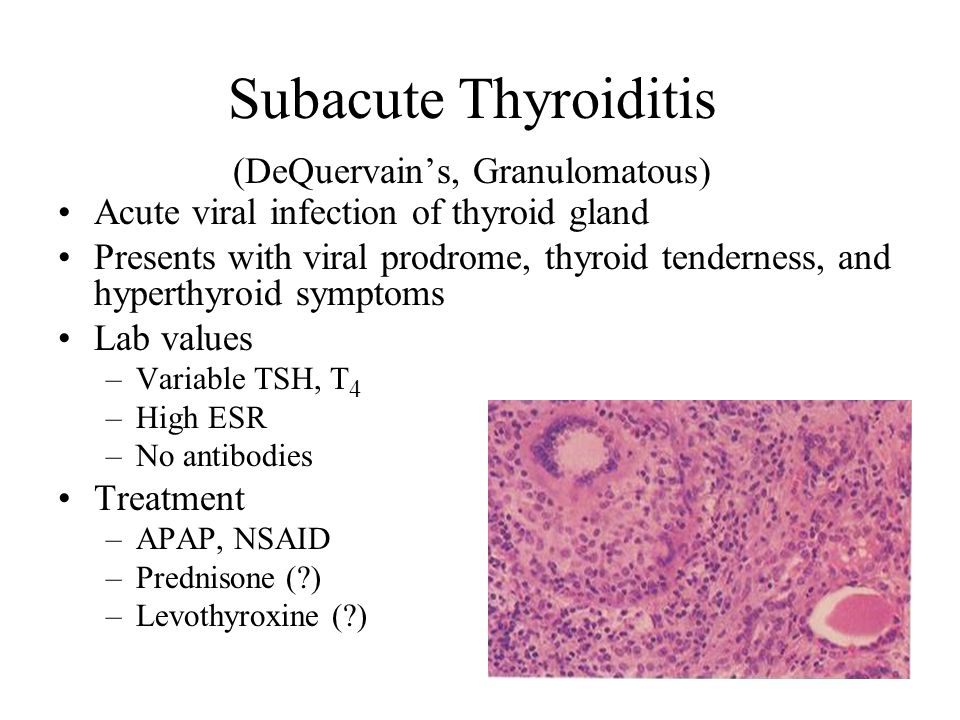 Subacute Thyroiditis (DeQuervain’s, Granulomatous) Acute viral infection of thyroid gland Presents with viral prodrome, thyroid tenderness, and hyperthyroid symptoms Lab values –Variable TSH, T 4 –High ESR –No antibodies Treatment –APAP, NSAID –Prednisone ( ) –Levothyroxine ( )