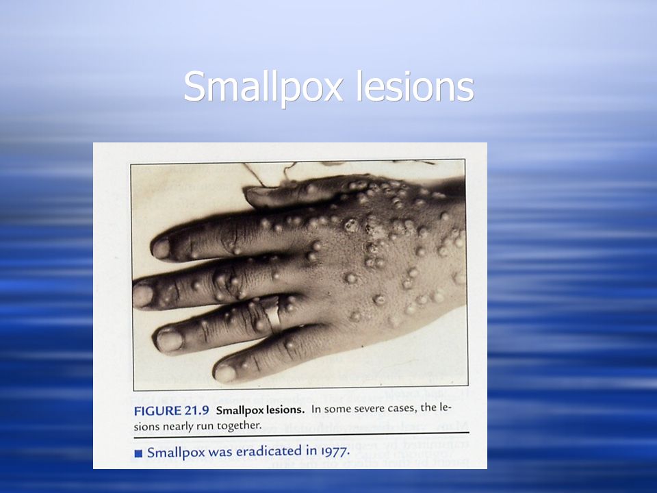 Smallpox lesions
